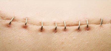 advanced wound healing treatments